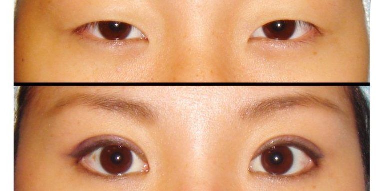 chinese eye surgery