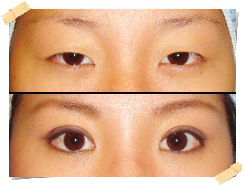 Chinese eyelid surgery