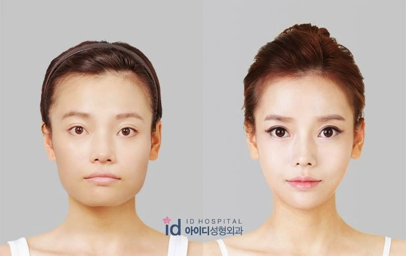 Chinese facial surgery