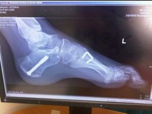 X-ray of a foot with metal pins inside