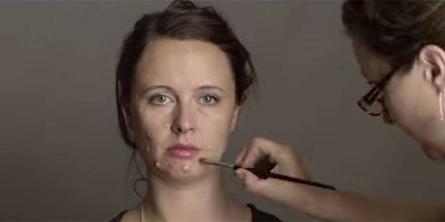 Adult acne transformation videos