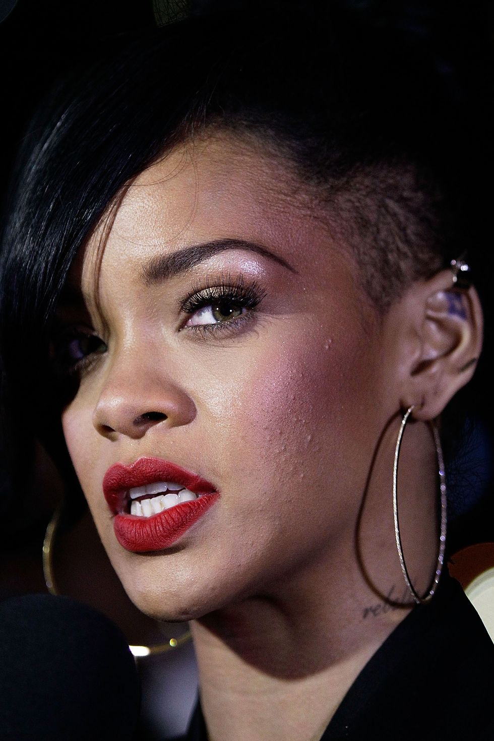 Rihanna acne bad skin