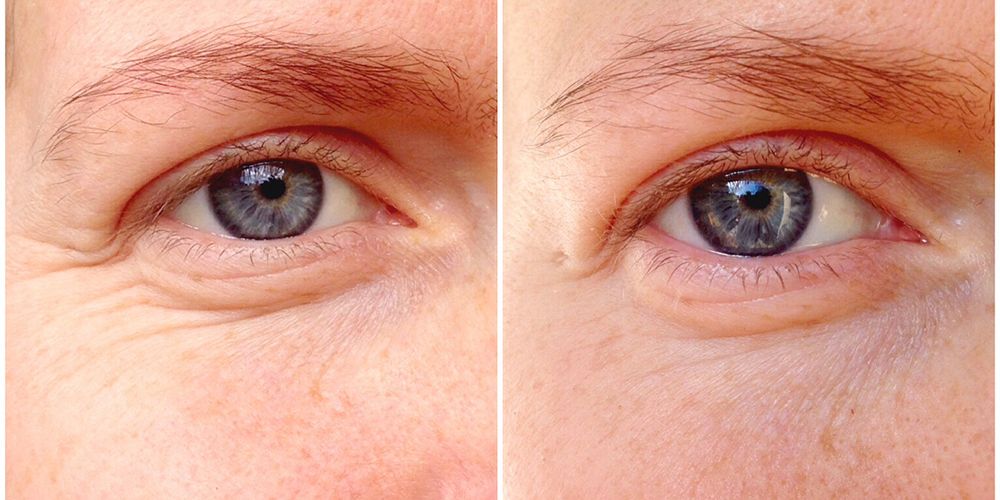 nrm 1412950515 ozone gel eye wrinkles before and after hp.jpg?crop\u003d0