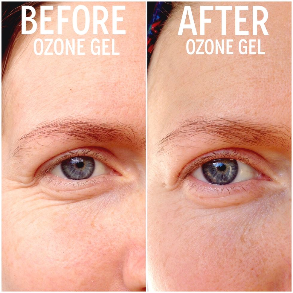 before after ozone gel