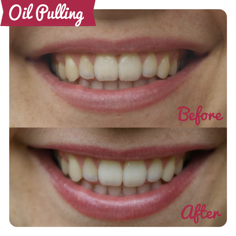 Can oil pulling for a fortnight transform your teeth? Oil pulling before and after review - Cosmopolitan.co.uk