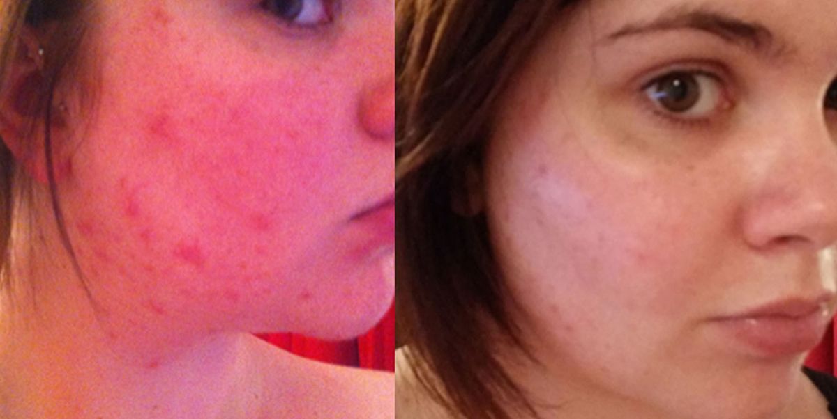 Seneste nyt kold genopretning La Roche-Posay Effaclar Duo+ :: before and after pictures