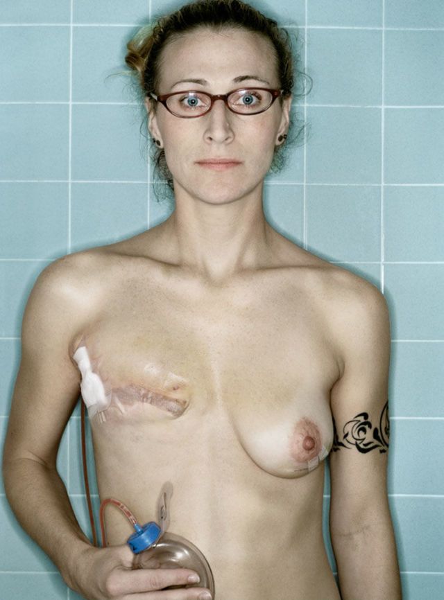 15 raw photos of a woman's breast cancer treatment
