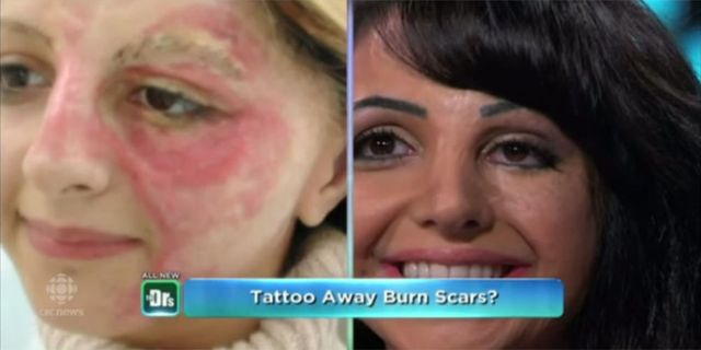 Tattoo artist conceals burn victim's scars - the new technique changing the lives of those bearing serious scars