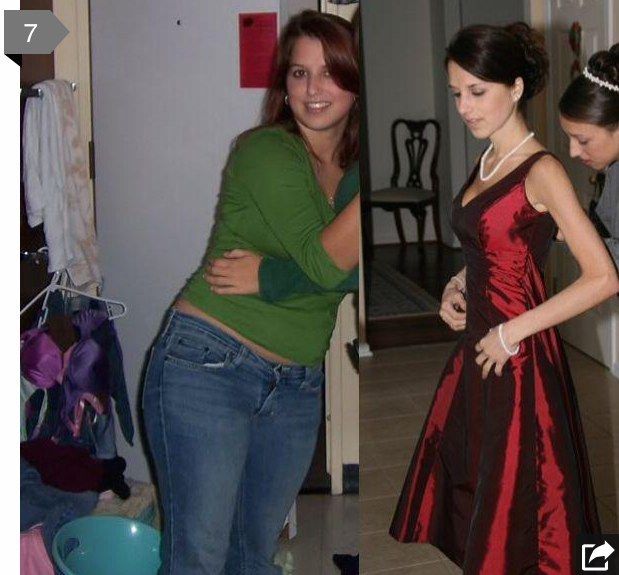 Website uses a woman's anorexia recovery photos in a post about 'amazing' weight loss