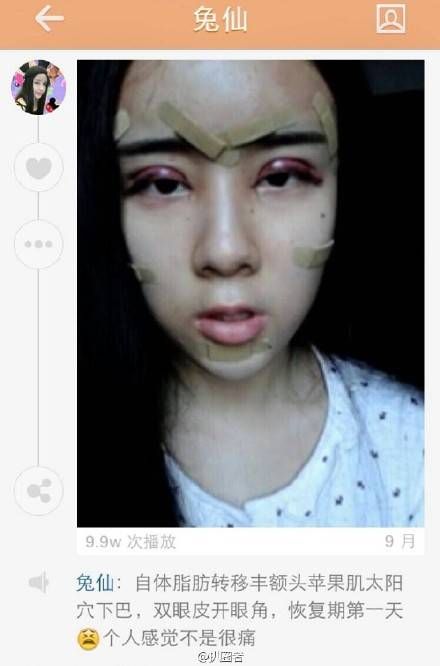 15 year old girl gets extreme plastic surgery