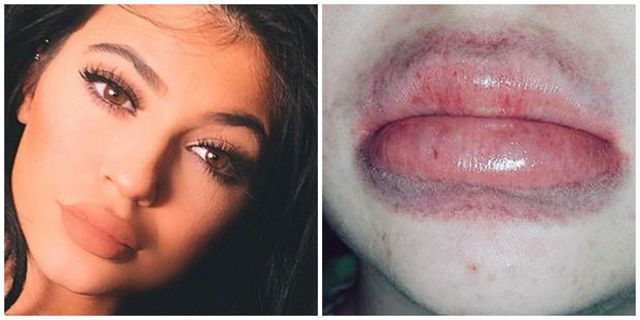 Kylie Jenner lip challenge went wrong