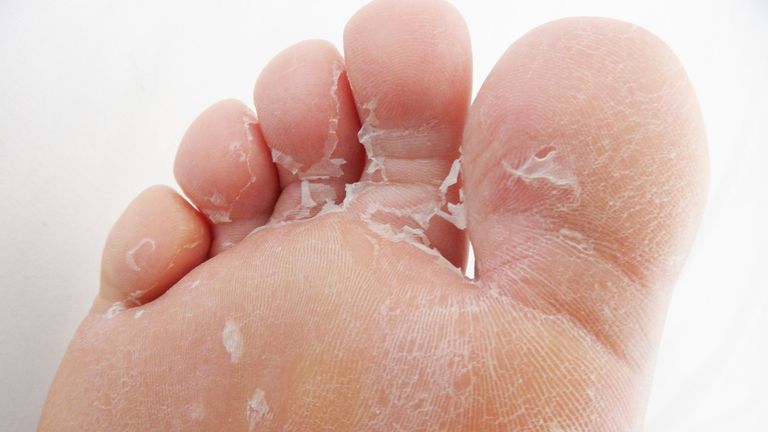 Foot Care: How to Remove Thick Dead Skin From Your Feet