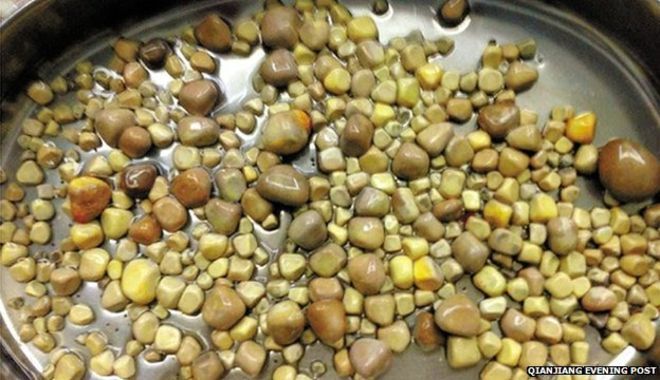 420 kidney stones removed after too much tofu