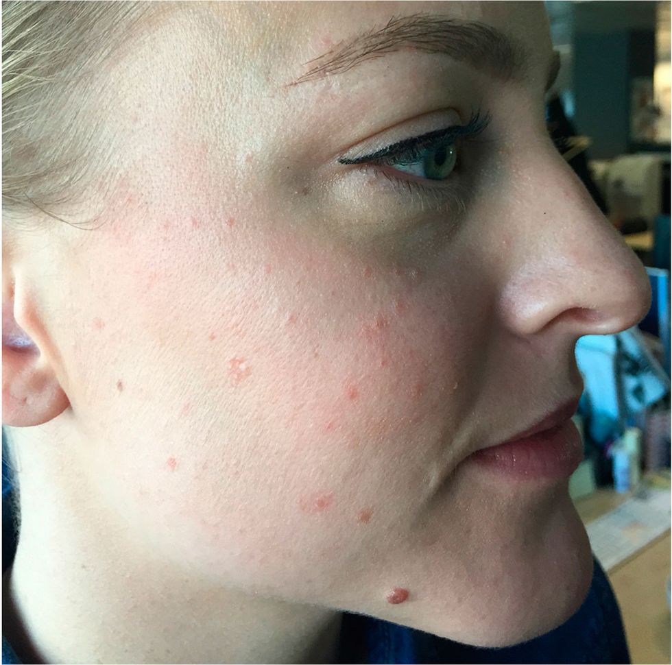 Adult acne - before picture