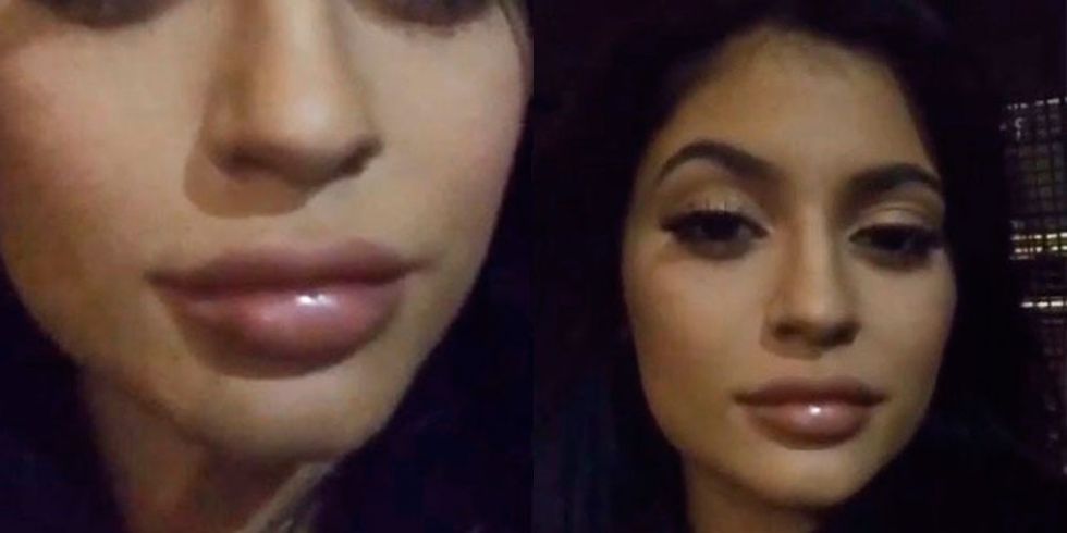 Kylie Jenner's swollen lips look bigger in latest Snapchats