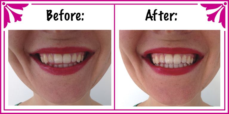How to make an all-natural teeth whitening treatment