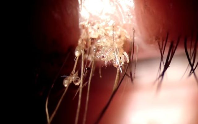 What a crab louse infestation on your eyelashes looks like