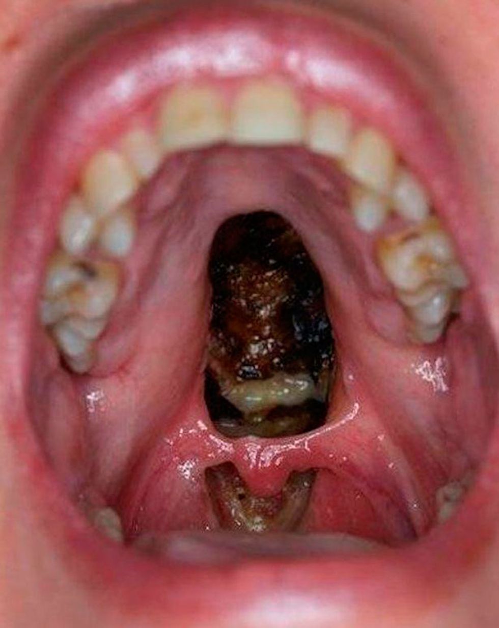 Cocaine damage to mouth