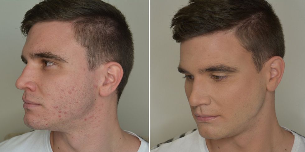 Philip, 23, acne sufferer