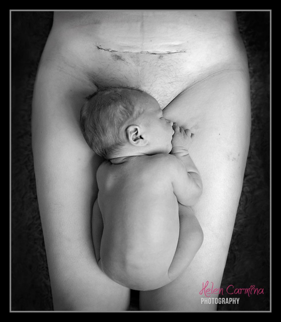 Viral caesarean scar baby photo