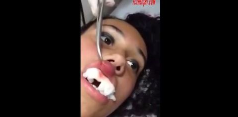 girl gets maggot removed from lip