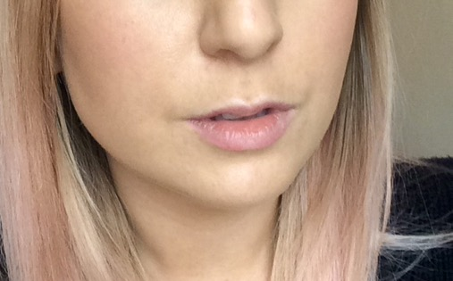 Chloe's lips before fillers