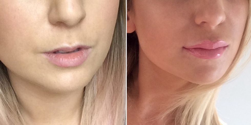 Chloe's lips before and after