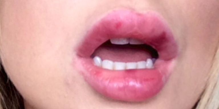 lip fillers really feels