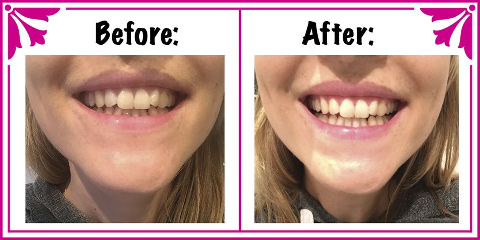 charcoal teeth whitener review