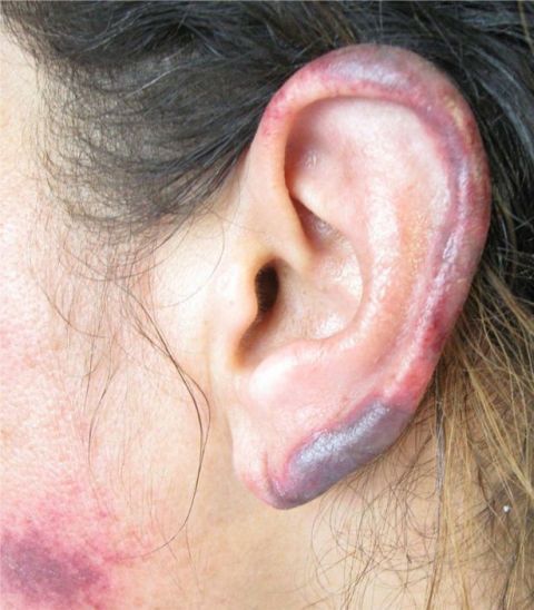 Cocaine rots your skin and turns your ears black