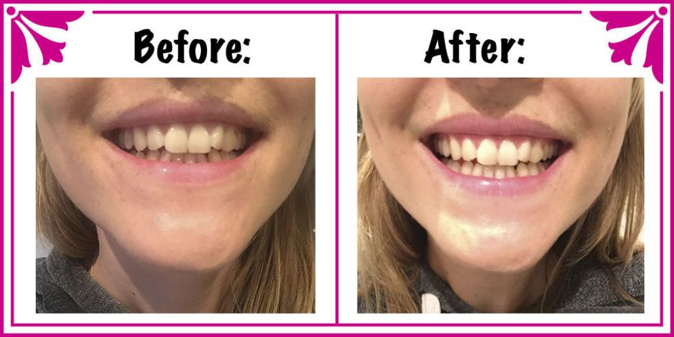 black diamond toothpaste before and after