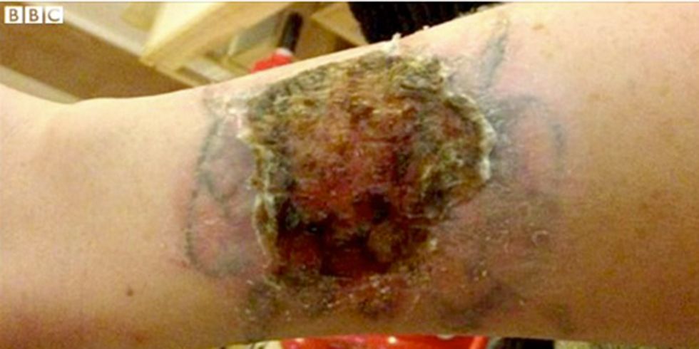 Woman left with horrific burns from a DIY tattoo removal kit