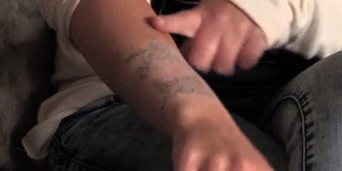 woman left with horrific burns from a diy tattoo removal kit woman left with horrific burns from a diy tattoo removal kit