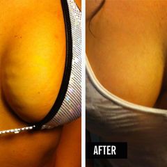 Women Are Getting Vampire Breast Lifts to Plump Their Boobs