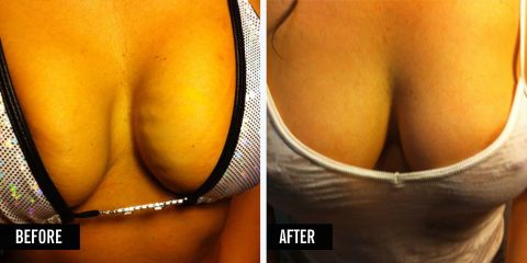 Women Are Getting Vampire Breast Lifts to Plump Their Boobs