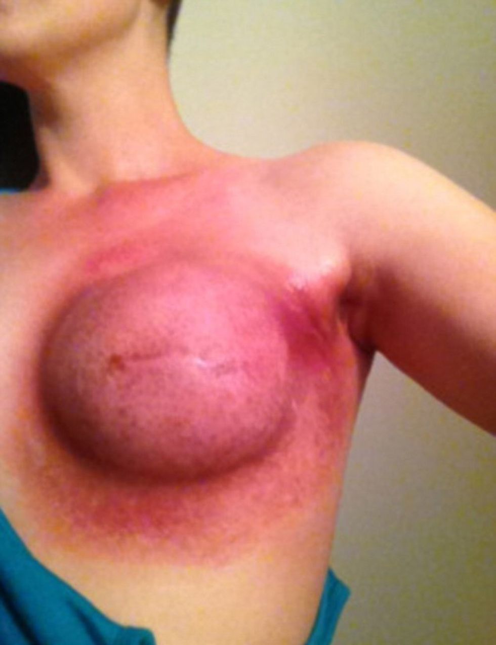 Woman shares graphic post-treatment photos to reveal the devastating effects of the disease