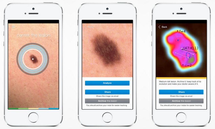 'melanoma detection app' SkinVision