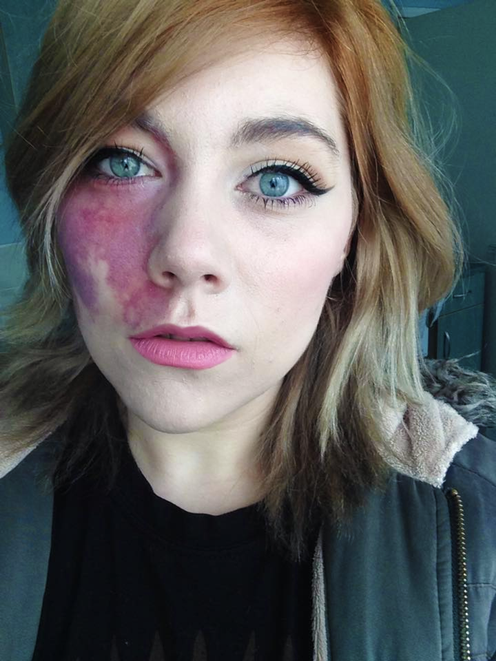 What happened when one inspiring woman shared her birthmark photos