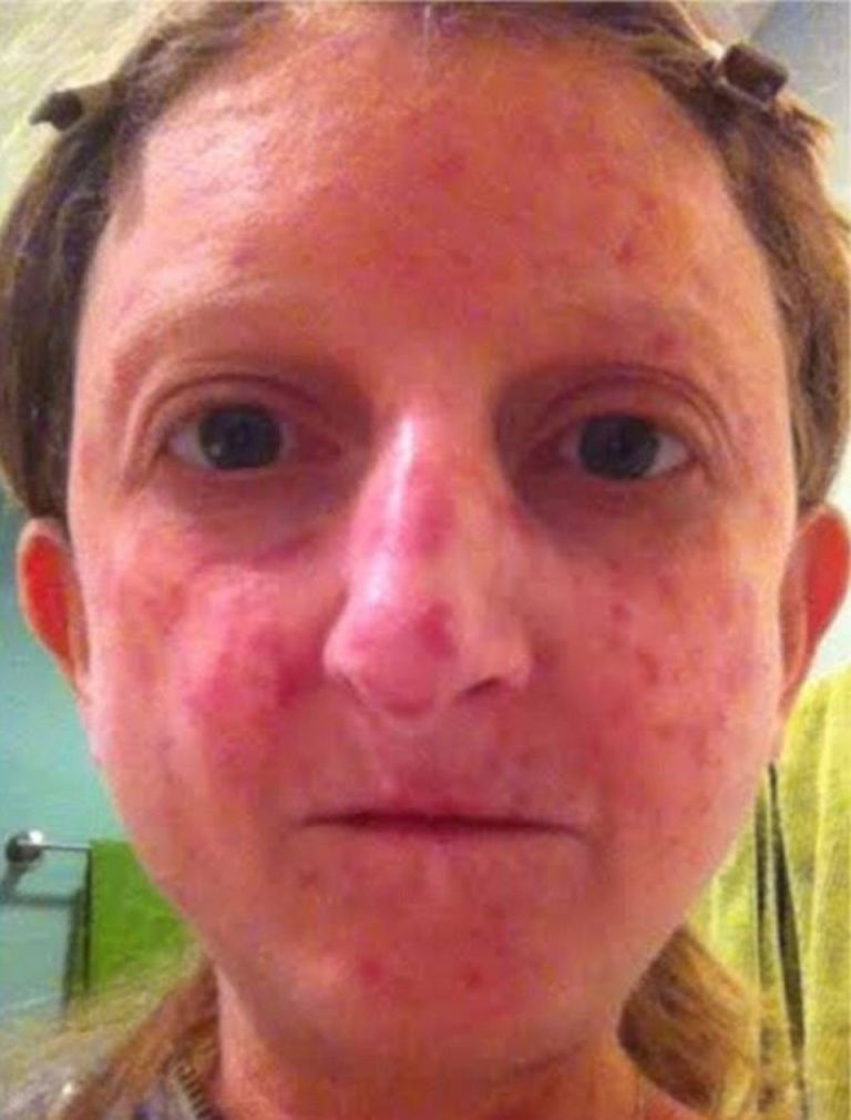<p>After 30 years of concealing her face from the world, writer Goodman-Helfand took off her makeup and shared an eye-opening, bare-faced selfie that showcases her symptoms of scleroderma, a rare autoimmune disease that causes a hardening of the skin. When Facebook refused to post the photo due to "negative feedback," the internet fought back, and an awareness campaign, #SclerodermaSelfies, was launched.</p>