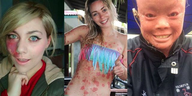 Women with rare skin conditions - women speaking out against bullying