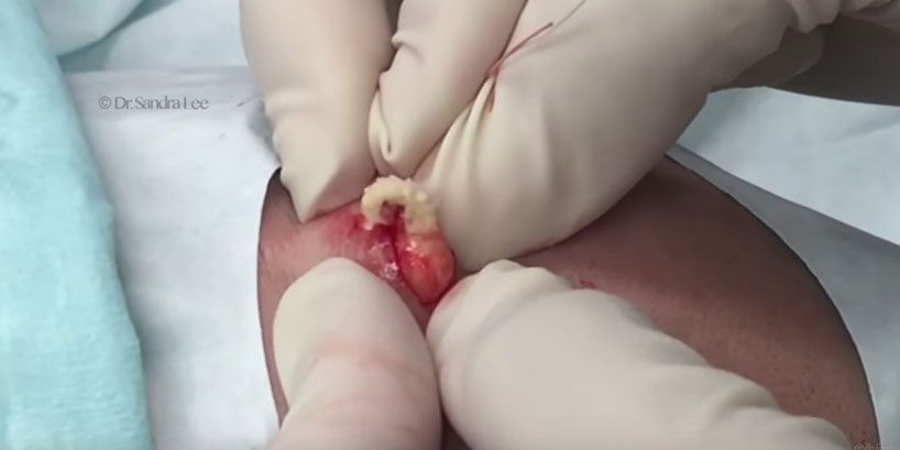 A cyst being excised.