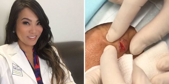 dr pimple popper makes pimple popping videos
