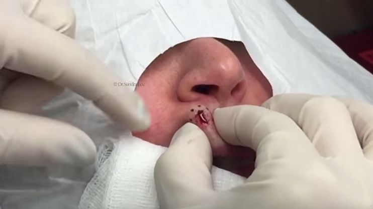 Blackheads  Dr Pimple Popper 