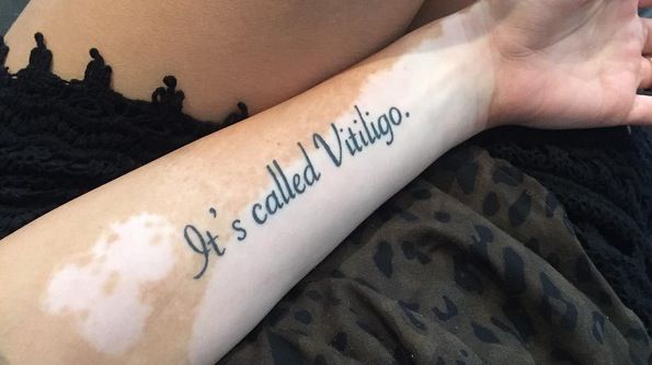 Vitiligo and Tattoos: Everything You Need to Know - AuthorityTattoo