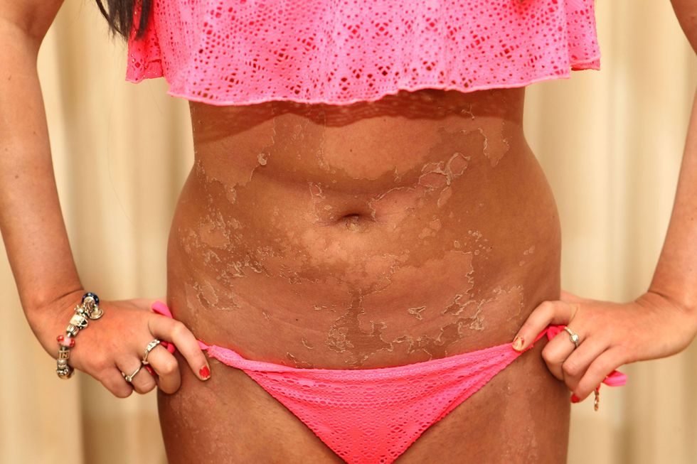 Model Alkhatib suffered awful blistering after spending half an hour on a sunbed