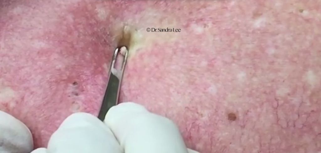 Hjælp depositum tempo Dr. Pimple Popper's newest video is both horrifying and fascinating