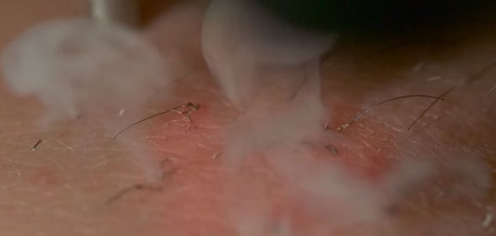 What laser hair removal looks like close up