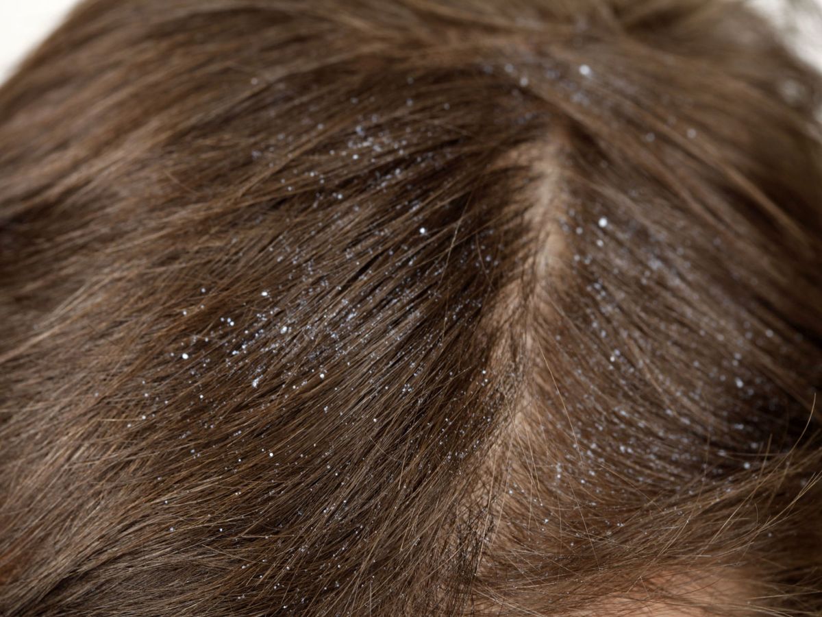 This surprising DIY hair hack gets rid of dandruff