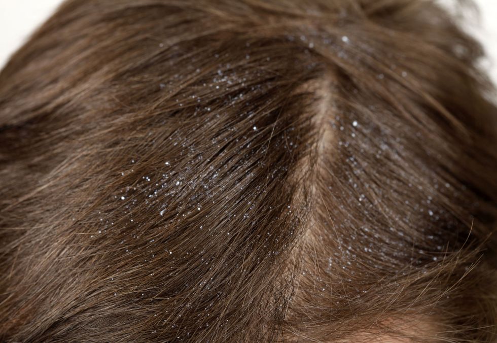 This surprising DIY hair hack gets rid of dandruff