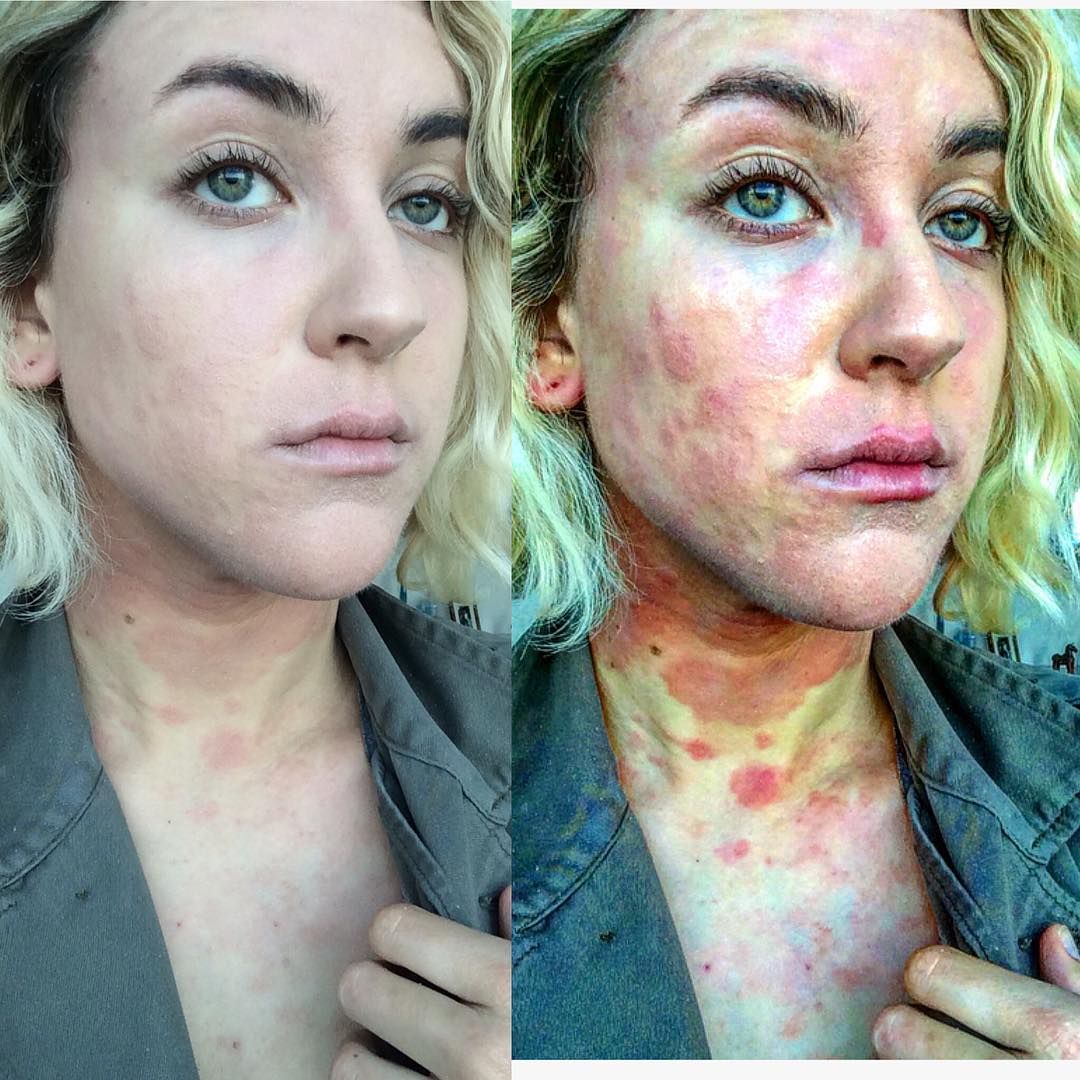 An Actress Shared Shocking Photos Of Life With Psoriasis